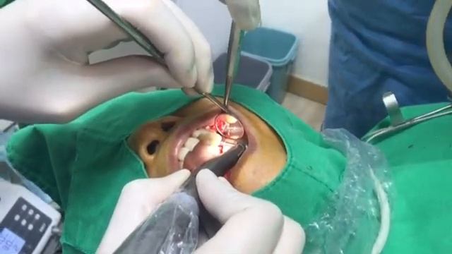 How I place an implant on the upper left maxilla смотреть онлайн
