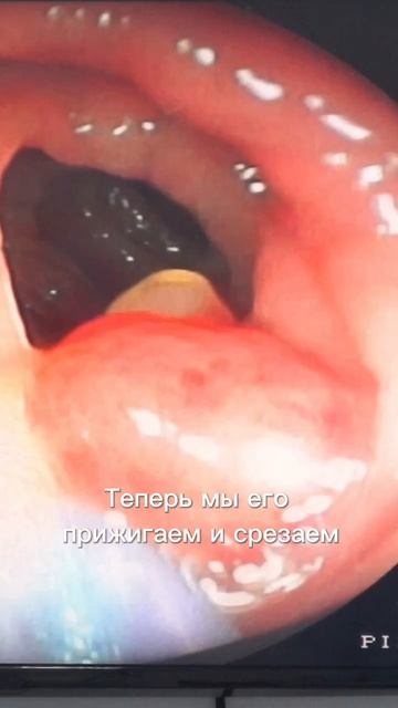 Удаление полипа