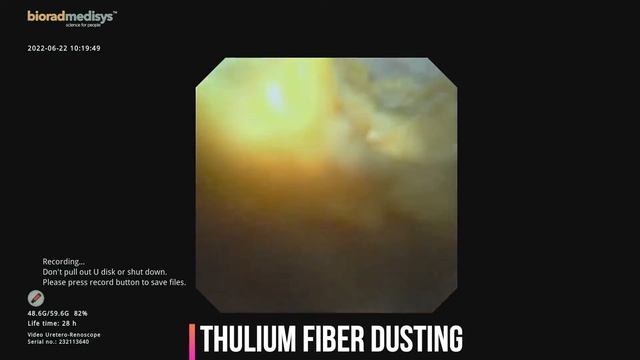 RIRS ADVANCE LASER KIDNEY STONE SURGERY BY DR HARSHAWARDHAN TANWAR смотреть онлайн
