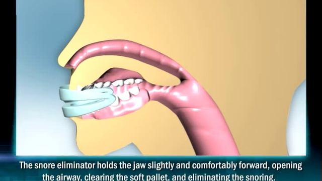 How Anti-Snoring Device Works смотреть онлайн