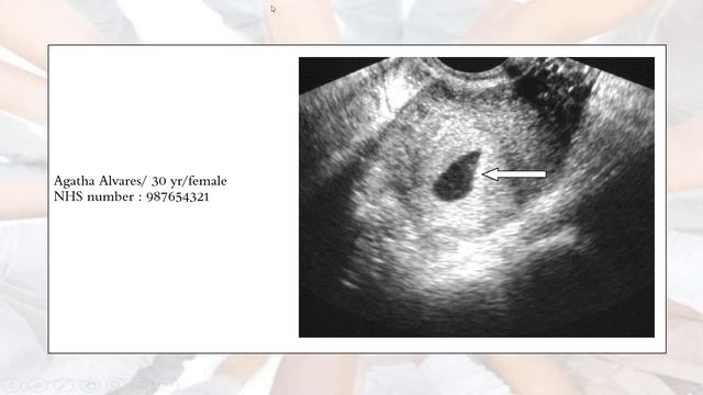 Structured Discussions : Renal transplant, Early pregnancy loss, Acute abdomen- Dr Ankita Joshi смотреть онлайн