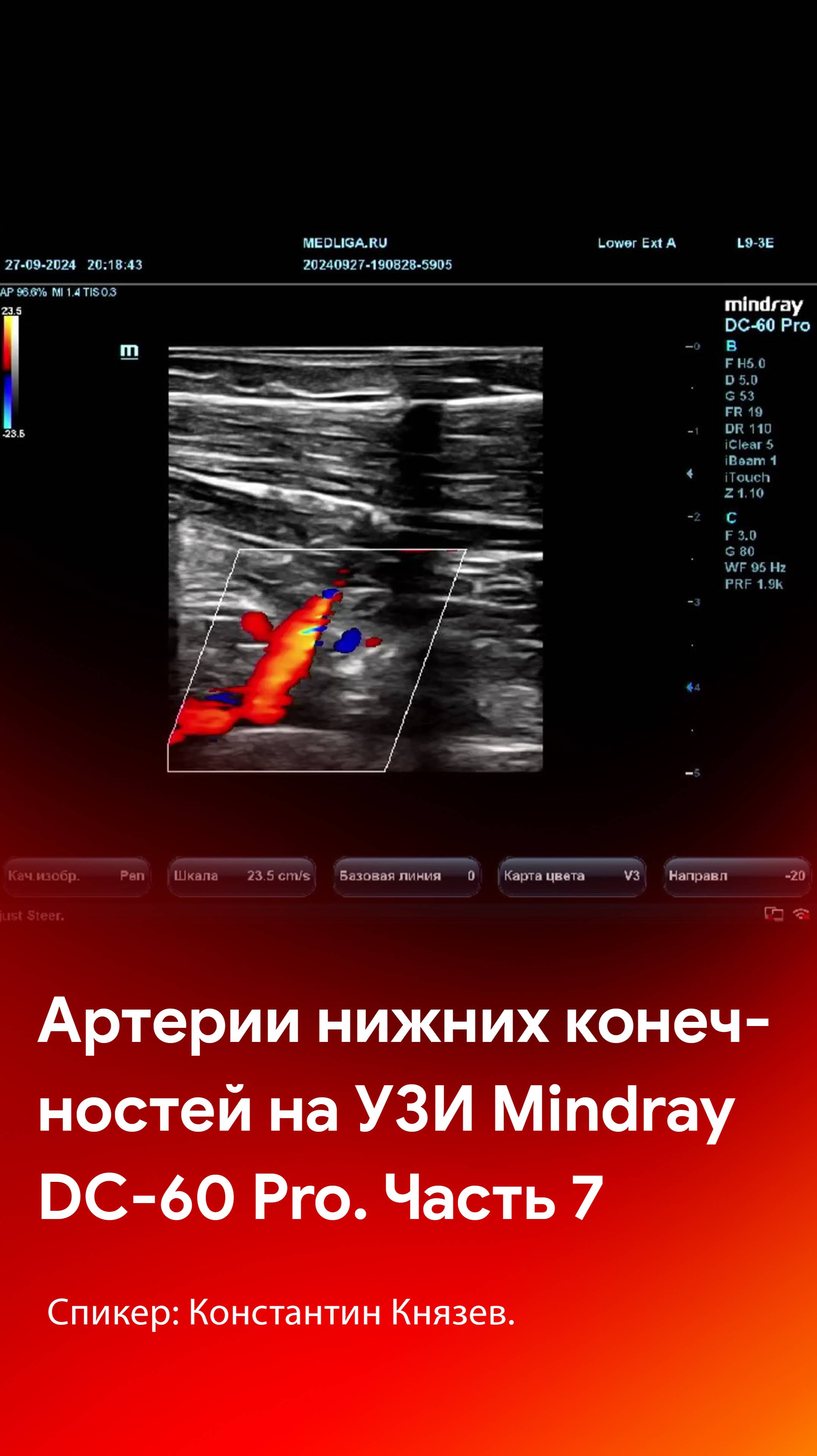 Мастер-класс по УЗИ артерий нижних конечностей на Mindray DC-60 Pro. Часть 7 смотреть онлайн
