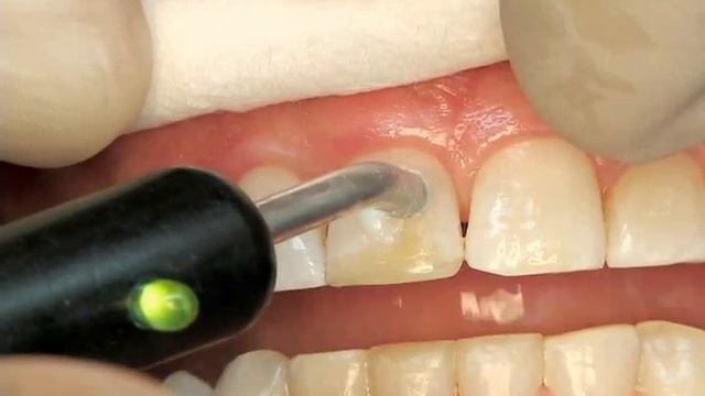 Electrical PulpTest смотреть онлайн