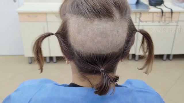 Как формируется донорская зона у женщин для бесшовной процедуры пересадки волос☀️ смотреть онлайн