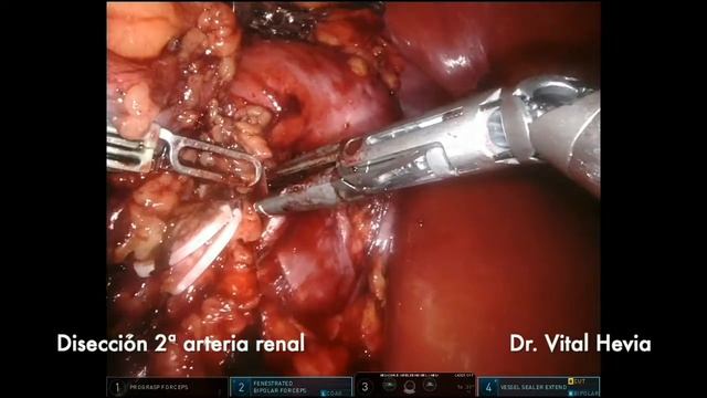 Robot assisted radical nephrectomy - 2 undetected arteries & early vein clip - Dr. Vital Hevia смотреть онлайн