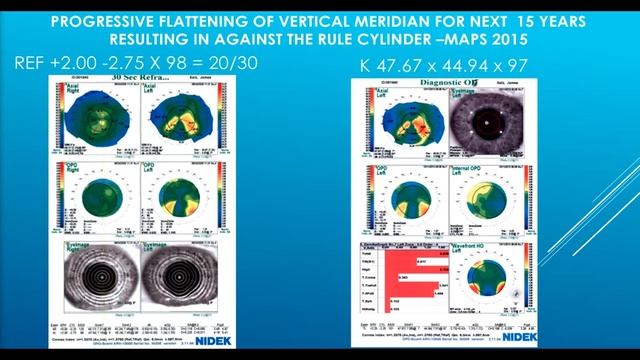 James Salz - Topography-Guided PRK for Irregular Astigmatism in my Left Eye смотреть онлайн