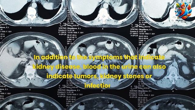 Kidney Health Alert: 10 Odd Signs to Watch For смотреть онлайн