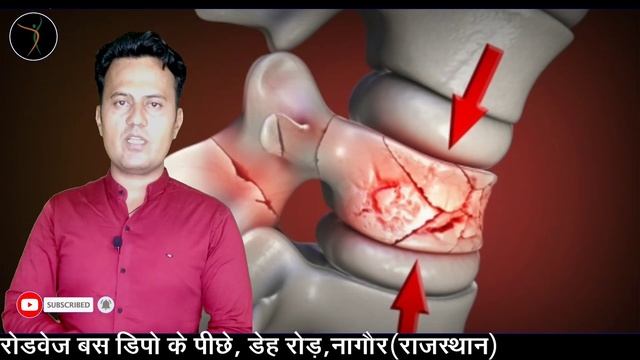 रीड की हड्डी के फ्रैक्चर के बाद कौनसे मरीज नही  चल पाते?SpineFracture Complete S.C.I IncompleteS.C.