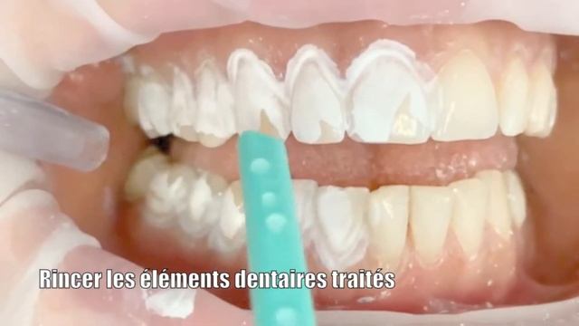Dentin Desensitizer Application (Française) смотреть онлайн