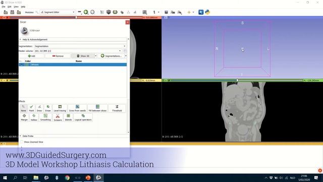 Tutorial for renal calculus volume estimation in 3D slicer смотреть онлайн