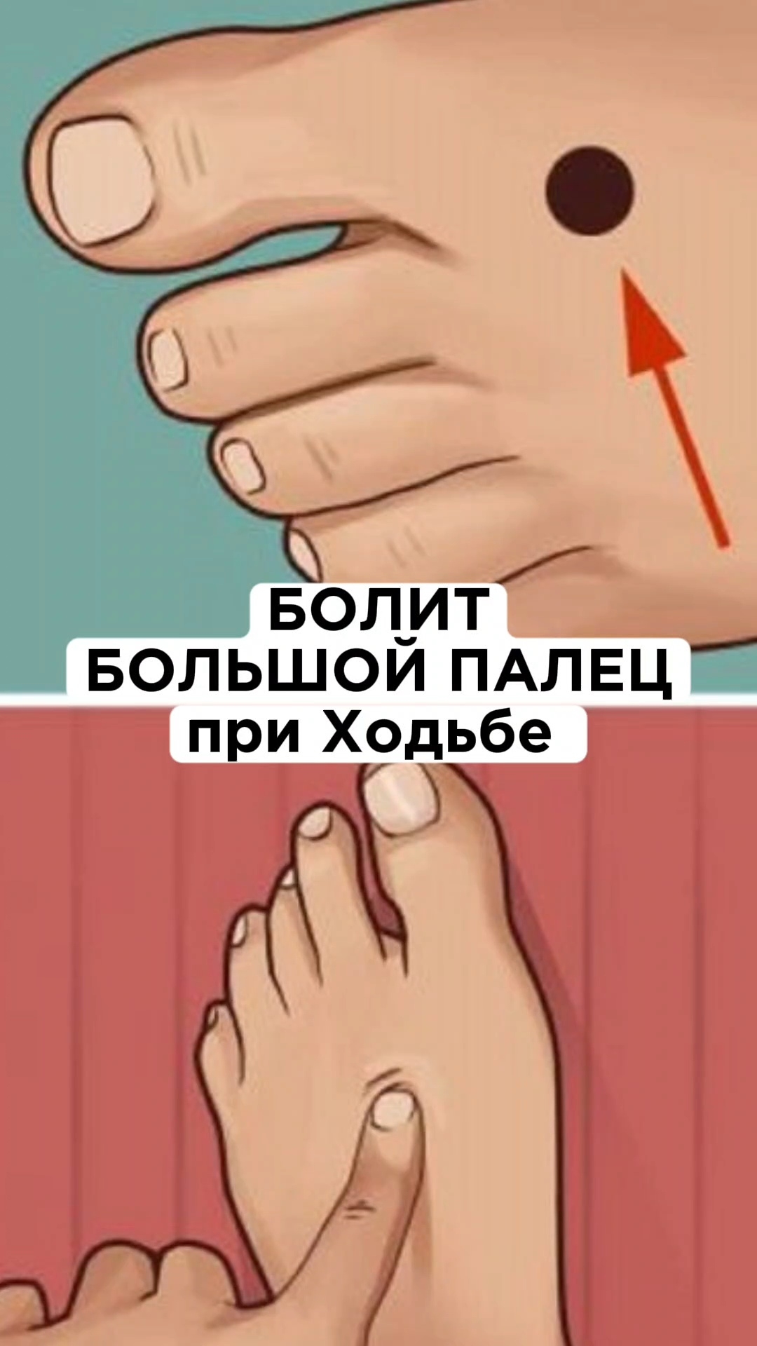 Почему Болит БОЛЬШОЙ Палец при ходьбе? #плоскостопие #перекостаза #стельки #школаног #больвноге смотреть онлайн