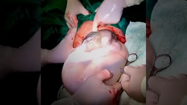 الكيس الامنيوسي ambiotic sac смотреть онлайн