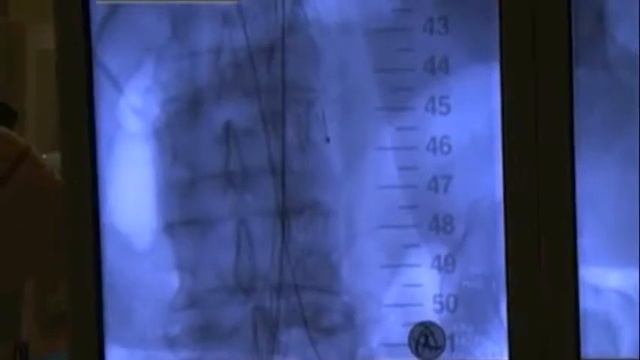 BRACHIO-FEMORAL LOOP AND THROMBIZATION OF ANEURYSM SAC (PART 2)-Vascular Surgery смотреть онлайн