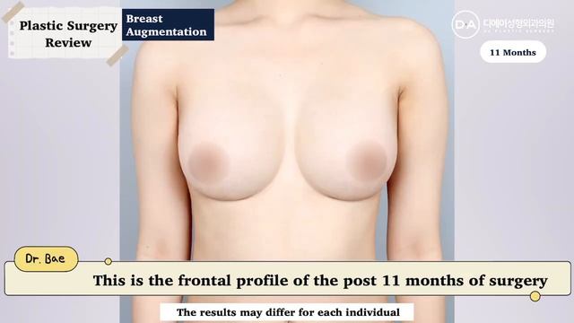 [Plastic Surgery Korea] With Breast Augmentation Get Natural U Line Breasts At DA Plastic Surgery! смотреть онлайн