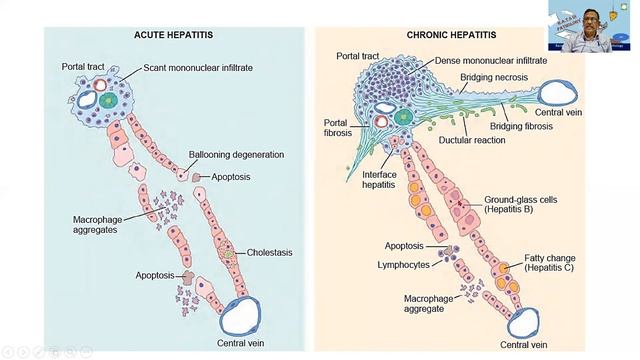 Viral hepatitis | Liver | R.A.T.S | Pathology | MBBS | Dr GSS | University questions !!! смотреть онлайн