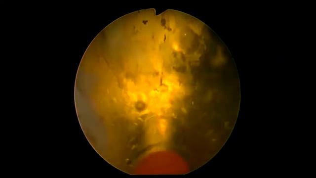 Green light Laser vaporization of the prostate смотреть онлайн