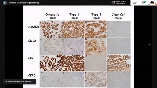 Pursue 1 Special- Session 3 (Live): Multiple Facets of Eosinophilic Renal Neoplasm смотреть онлайн