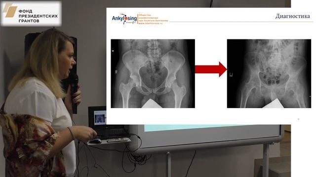 Агафонова Е.М.: Коксит - причины, симптомы, лечение (Школа для пациентов с болезнью Бехтерева) смотреть онлайн