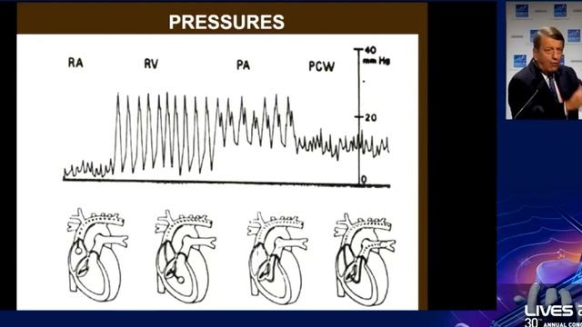 The role of continuous PAC in today’s ICU JLV 2017