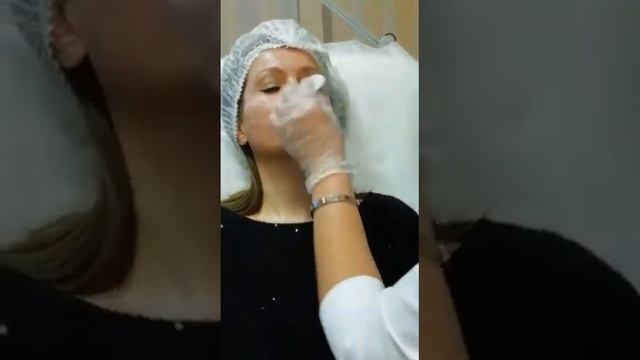 Филер в скуловую часть 3 смотреть онлайн