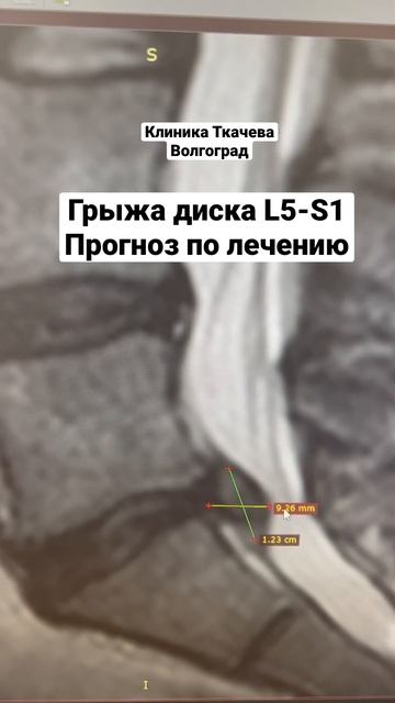 Грыжа диска L5-S1. Прогноз по лечению. смотреть онлайн