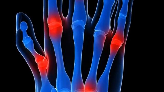 Большие проблемы и маленькие победы в борьбе с ревматоидным артритом и болезнью Бехтерева.2010 смотреть онлайн