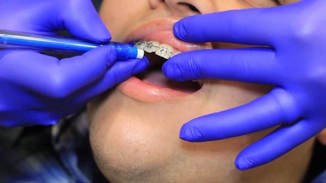 Eraser To Tuck Wire - Sky Orthodontics OKC смотреть онлайн
