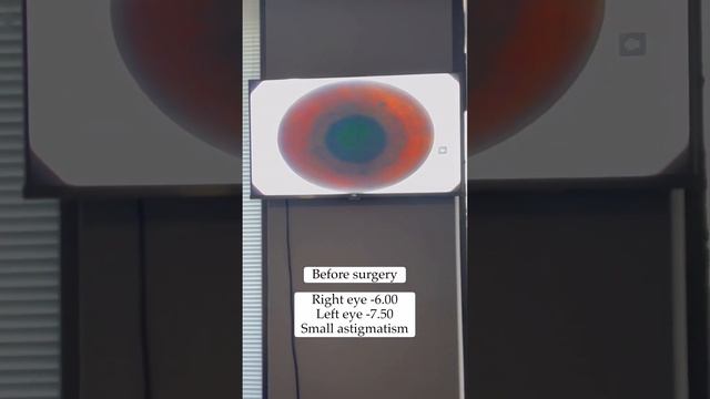 SMILE Laser Eye Surgery - Xiaolin смотреть онлайн
