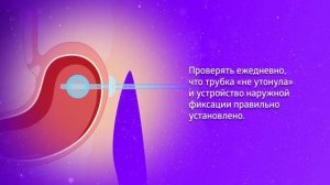 Гастростома и когда она нужна?