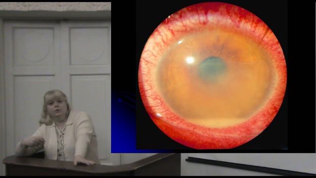 Увеиты и иридоциклиты при болезни Бехтерева - Вахова Е.С. доцент Кафедры глазных болезней МГМСУ смотреть онлайн