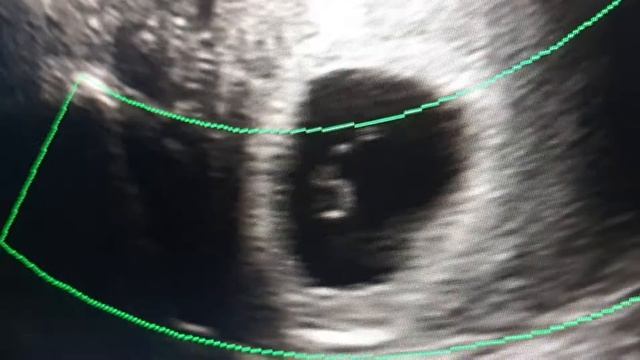 5 неделя. желточный мешочек. 26 октября 2020(2) смотреть онлайн