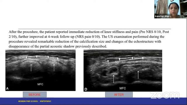 Ultrasound Guided Knee MIPSI 💉⚡ :: PAIN JOURNAL CLUB #MPSPAINJC No. 36 смотреть онлайн