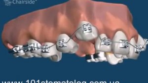 Как работают брекеты