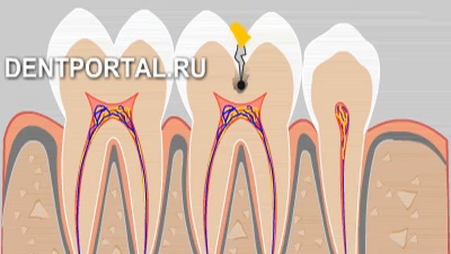 Фиссурный кариес смотреть онлайн