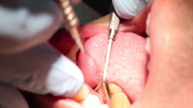 Deep Cleaning with Laser Treatment смотреть онлайн