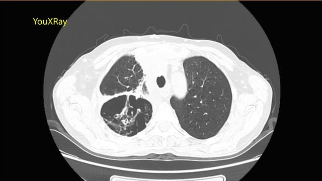 Лучевая диагностика аспергиллеза смотреть онлайн