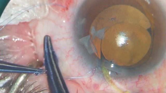 Dislocation of the "IOL + capsular bag" complex. Дислокация комплекса «ИОЛ+капсульный мешок». смотреть онлайн