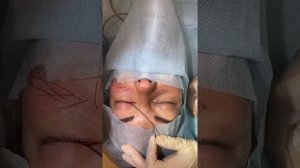 Нижняя блефаропластика