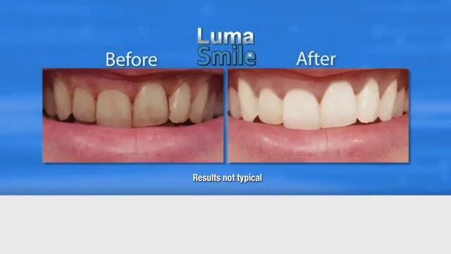 Luma Smile Tooth Polisher смотреть онлайн