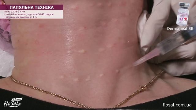 Ревіталізація шиї в папульній техніці. Мезококтейль Dermaheal SB💉
