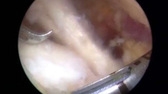 clever hook in rotator cuff.wmv смотреть онлайн