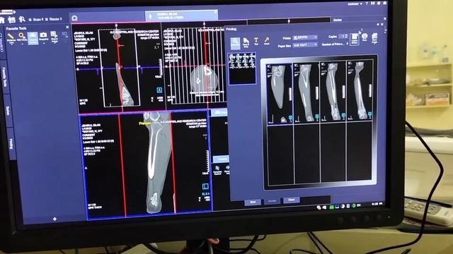 How can print CT Leg 3D films,Siemens healthineers SOMATOM. go CT Scan. смотреть онлайн