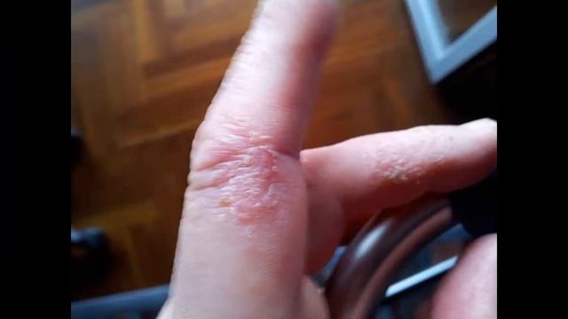 Псориаз и терапевтический напиток из листьев оливы.#псориаз смотреть онлайн