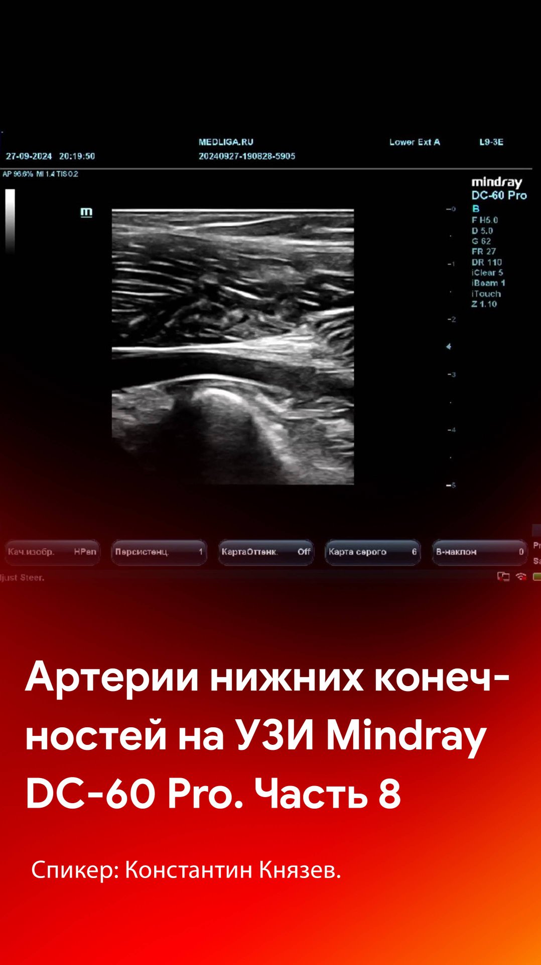 УЗИ артерий нижних конечностей на Mindray DC-60 Pro. Часть 8 смотреть онлайн