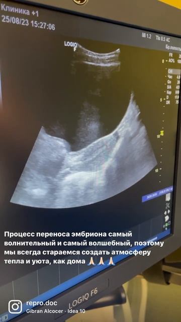 Перенос эмбриона женщине самый волшебный этап… #эко #repro_doc #эндометрий #беременностьэко смотреть онлайн