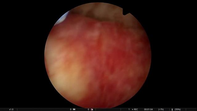 # ენდომტრიუმის პოლიპი#полип матки#endometrial polyp смотреть онлайн