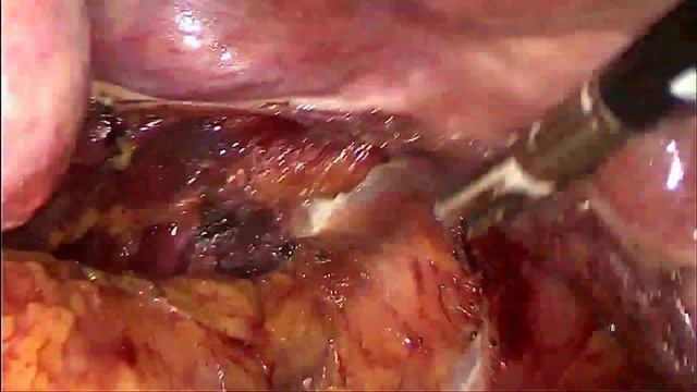 Chronic Constipation (Rectosigmoid Inertia) by Prof. Dr. Mahmoud Abd El-Naby смотреть онлайн