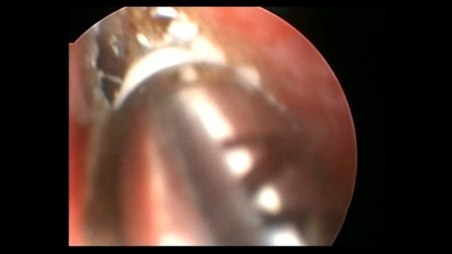 Эндоназальная коблационная дакриоцисториностомия, офтальмохируг Школьник С.Ф. смотреть онлайн