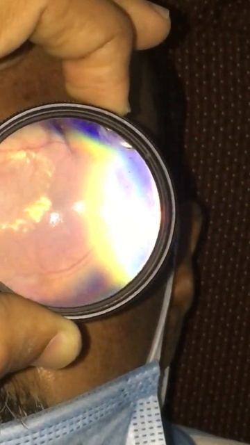 Diabetic retinopathy with circulate at maculopathy Dr Ajay Dudani смотреть онлайн