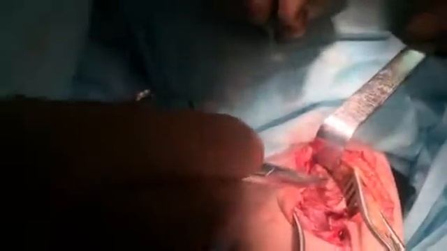 удаление кисты беккера2 смотреть онлайн